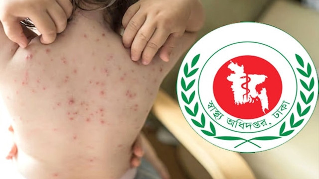 Measles Outbreak: 12 More Deaths in 24 Hours; Total Toll Reaches 451