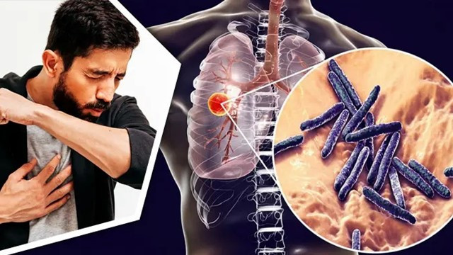 Deadly “White Plague” Tuberculosis Resurges in the United States