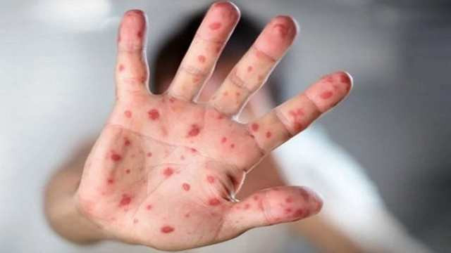 Pennsylvania Measles Outbreak Turns Deadly as Death Toll Rises to Three